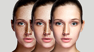 pigmentation_articlee_305x171.jpg